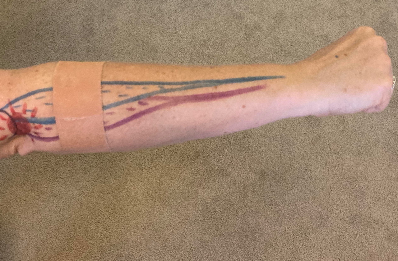 Where to position Strapping Tape to test for pain relief